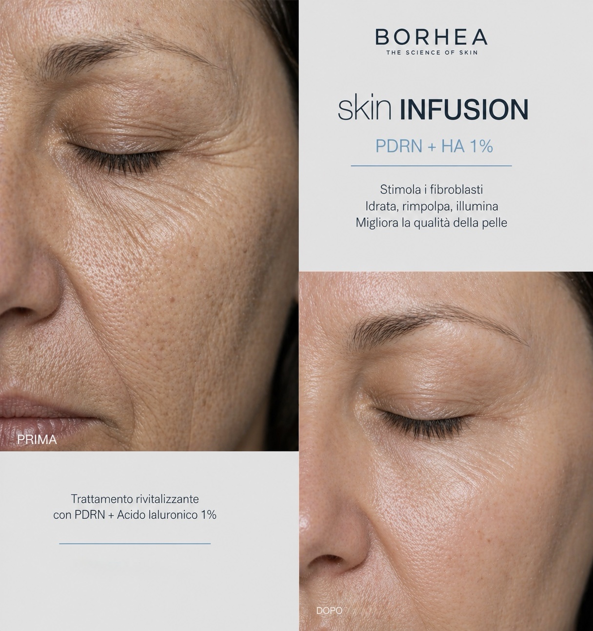 BORHEA SKIN INFUSION PDRN + HA 1% – 5x5 ml - immagine 6